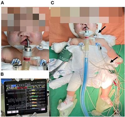 Case Report: Anesthetic Management and Electrical Cardiometry as Intensive Hemodynamic Monitoring During Cheiloplasty in an Infant With Enzyme-Replaced Pompe Disease and Preserved Preoperative Cardiac Function